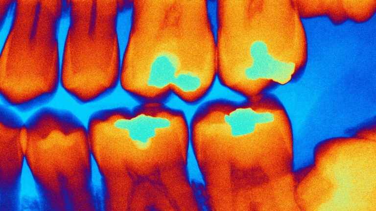 Ban on scanning fillings will change dentistry worldwide: ScienceAlert