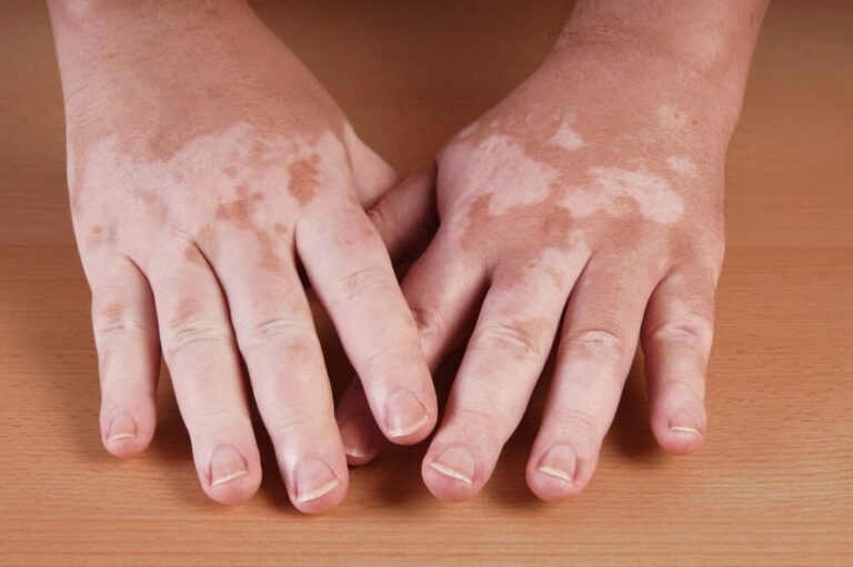 Comparison of site preparation methods for surgical treatment of vitiligo