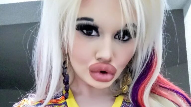 I had £20k of extreme plastic surgery people think i
