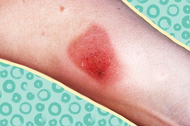6 Treatments, Causes and Symptoms