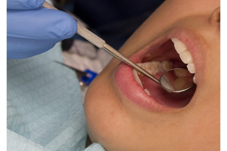 Gum disease may be linked to plaque buildup in the