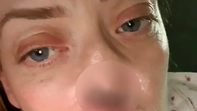 I went to Turkey for £3,000 but my nose collapsed on its own due to a rare risk people don’t talk about I went to Turkey for £3,000 but my nose collapsed
