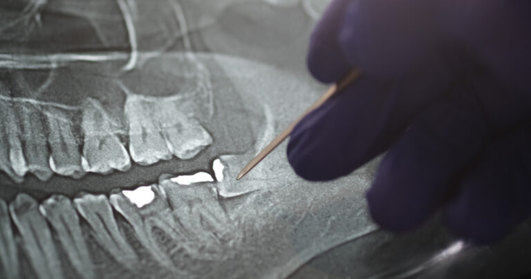 The move to phase out mercury in dental fillings is