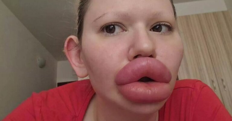 Woman spends £20,000 on 'world's biggest lips' but now doctors