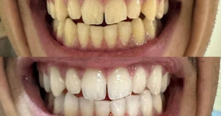 'Amazing' £20 teeth whitening strips make teeth look brighter and