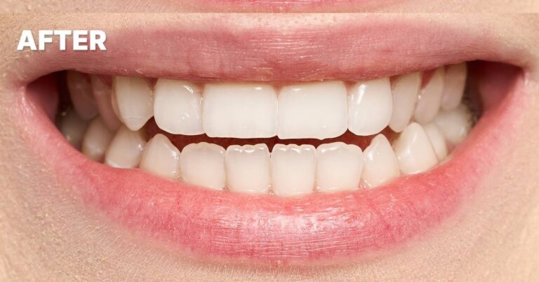 Dentist names three ways to stain free teeth, including 36p a day fix