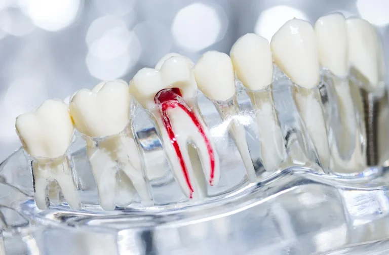 Root canal treatment Croydon General Dentistry Private patient appointments available