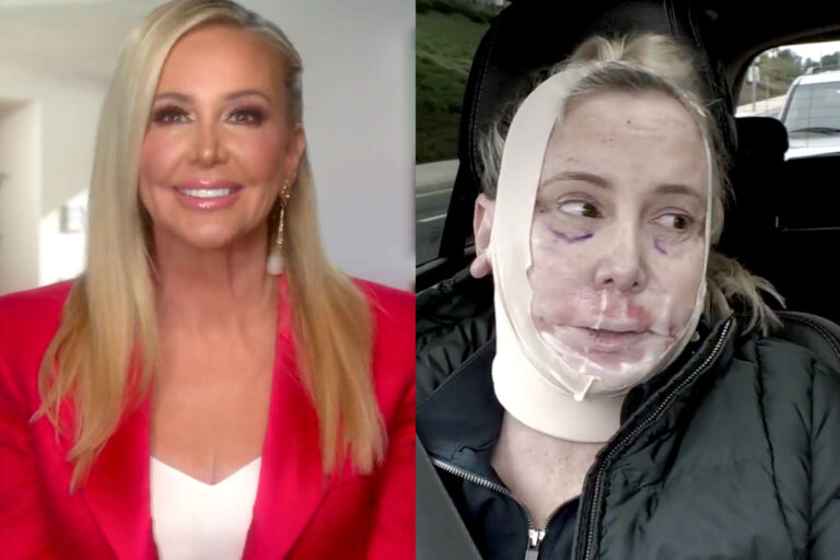 Shannon Beador’s no-scalpel facelift by Dr. Brian Reagan at CosmetiCare Shannon Beador's no scalpel facelift by Dr. Brian Reagan at CosmetiCare