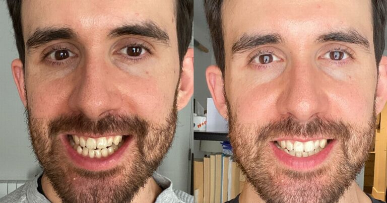The £30 teeth whitening strips that make them 'as white