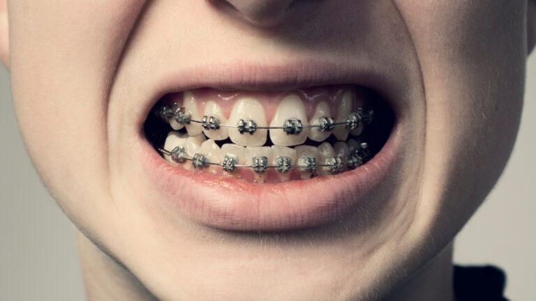 The origin of dental braces is not as ancient as